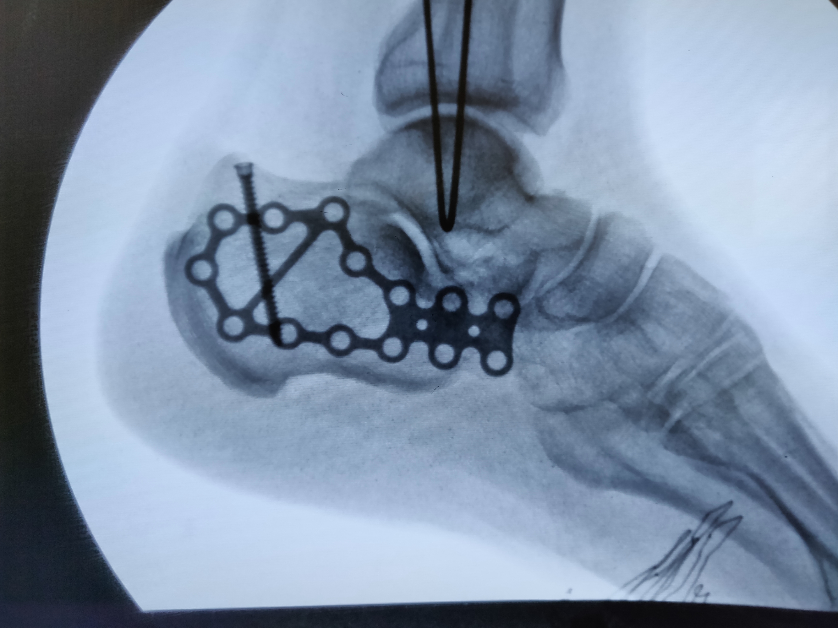 跟骨钢板图片
